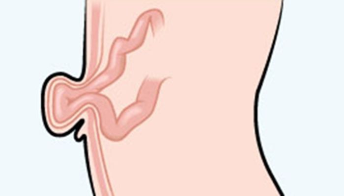 Inguinal Hernia: Sebepler, Belirtiler, Tedavi Nedenleri Inguinal Hernia: Sebepler, Belirtiler, Tedavi Nedenleri