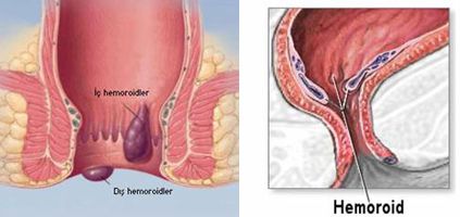 Hamile kadınlarda hemoroid - hızlı çözüm gerektiren hassas bir problem Hamile kadınlarda hemoroid - hızlı çözüm gerektiren hassas bir problem