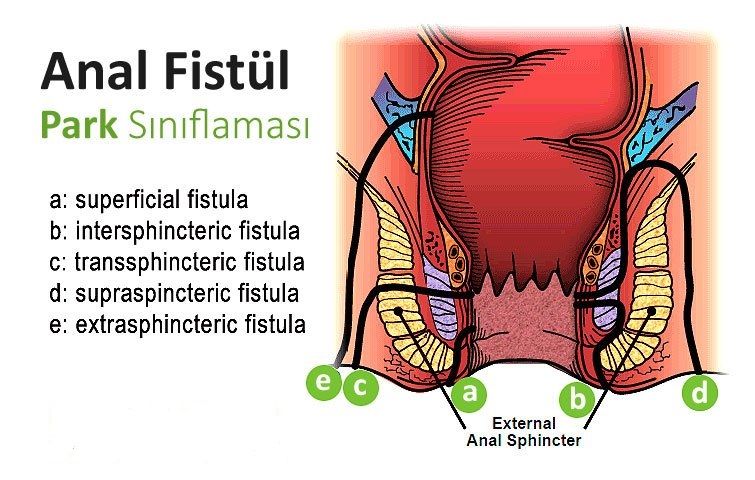 Anüs fistülü: nedenler, semptomlar, tedavi Anüs fistülü: nedenler, semptomlar, tedavi