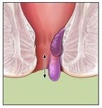 hemorrhoid3