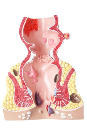 Dr Mehmet Güler Hemoroid Fistul Fissur